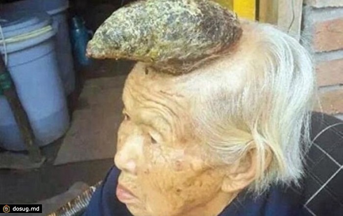 Родственники не разрешили делать операцию 87-летней "женщине-единорогу"