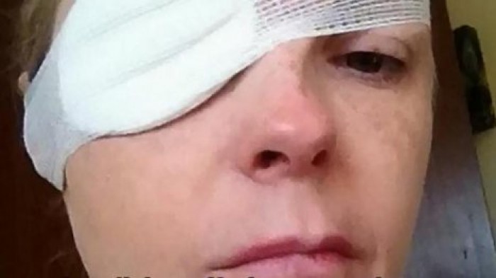 Паралич лица и немота: британка пострадала от укуса клеща