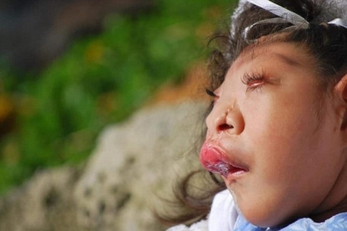 Родившаяся без части мозга девочка умерла в 10 лет