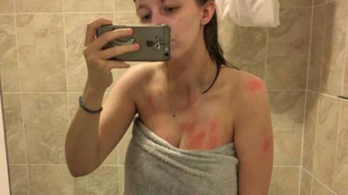 Ожоги от слез: британка испугала Сеть своими фото с аллергией на воду