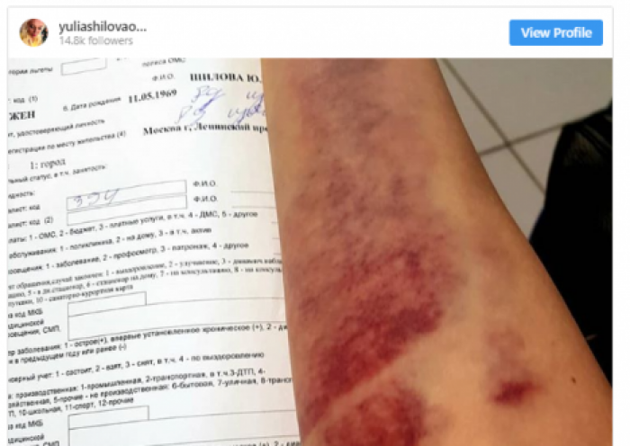 Писатель Юлия Шилова забиралась на 30 этаж по пожарному балкону и оказалась в гипсе