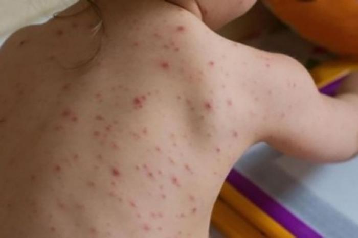 Восемь случаев заболевания корью в одной семье подтверждены лабораторией