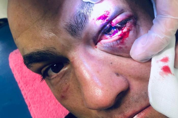 Бывший чемпион UFC показал рассеченное надвое веко после удара россиянина