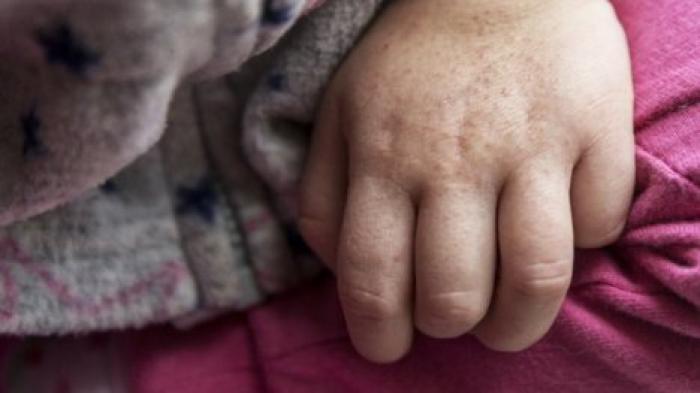 В Кишиневе зарегистрировали 23 новых случая скарлатины