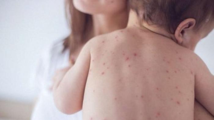 В июне в Молдове зарегистрировали 12 новых случаев заболевания корью