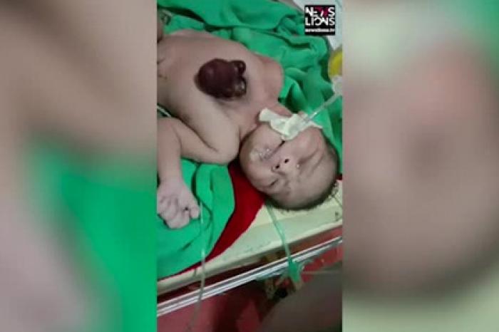 Ребенок родился с сердцем вне тела из-за редчайшего заболевания