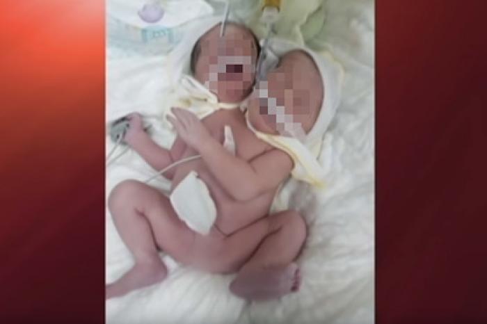 Опубликовано фото рожденного с двумя головами ребенка на Украине