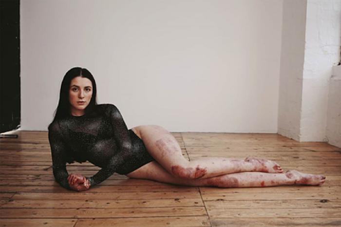 Студентка с редким заболеванием кожи снялась в купальнике для журнала Vogue