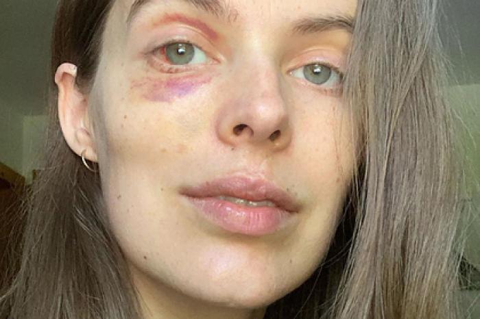 Модель показала гематомы на лице из-за заболевания и удивила поклонников