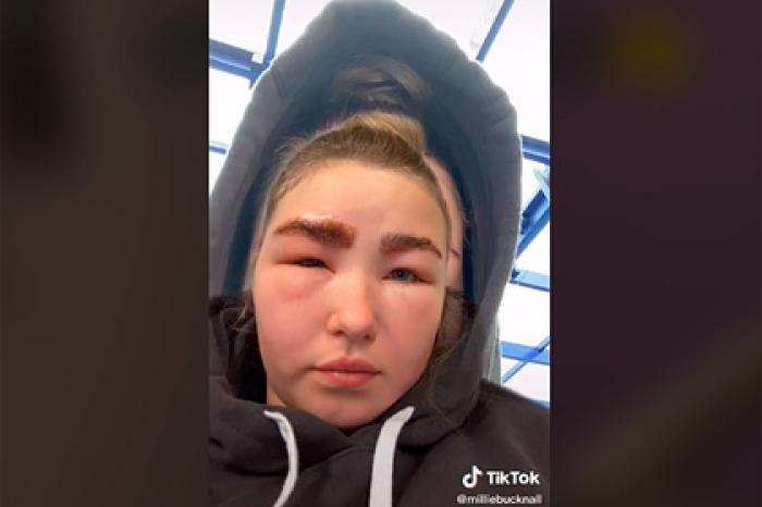 Девушка сходила в салон красоты, покрылась волдырями и не смогла открыть глаз