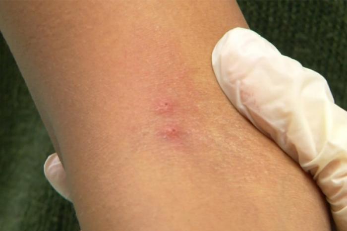 BOALA LYME DIAGNOSTICATĂ LA TREI COPII DIN CHIŞINĂU ÎN URMA MUŞCĂTURILOR DE CĂPUŞE