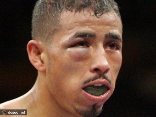 Боксер провел бой с переломом лицевой кости