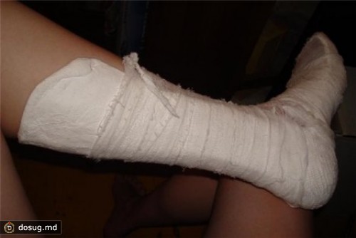 Кишиневец сломал ногу, упав в неогражденную яму