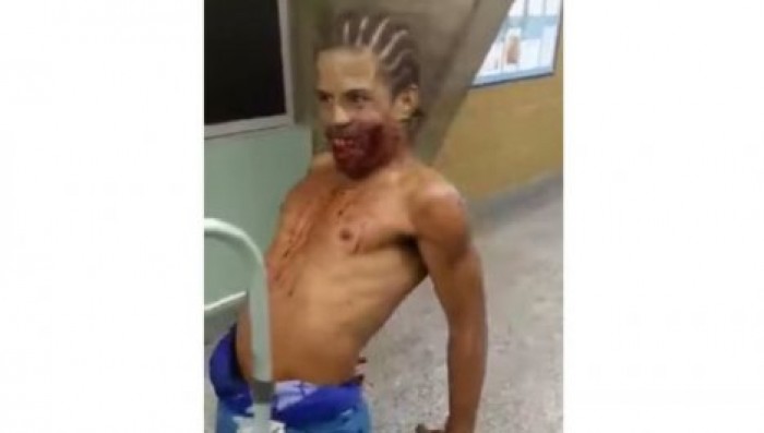 Раненный в лицо бразилец притворился зомби и напугал врачей. Видео