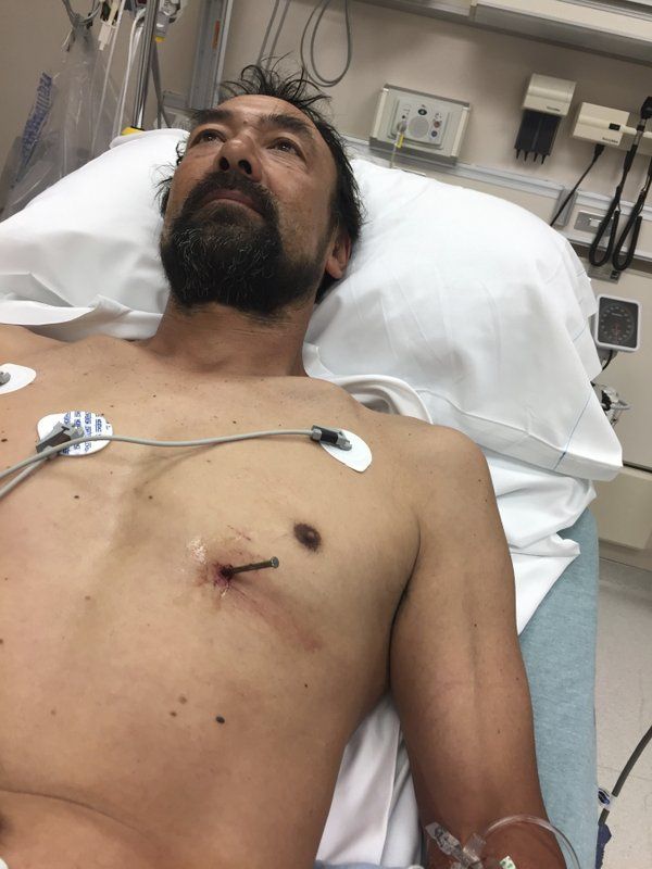 Мужик загнал себе гвоздь в сердце и сам приехал в больницу